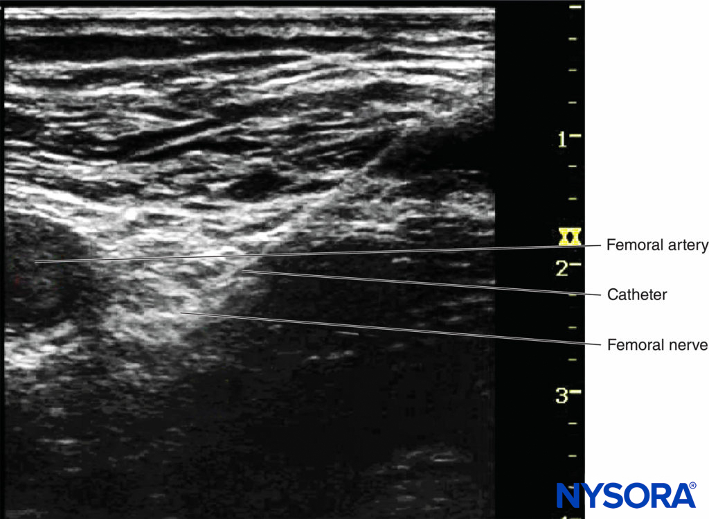 The catheter tip can be directly seen just beneath femoral nerve.