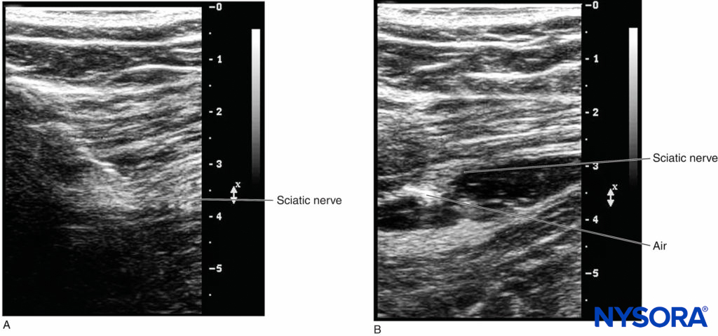 A: The location of the catheter tip cannot be visualized before a small amount of air is injected. B: The discernablebrightness indicates the location of the catheter tip when 0.3–0.5 mL air is injected.