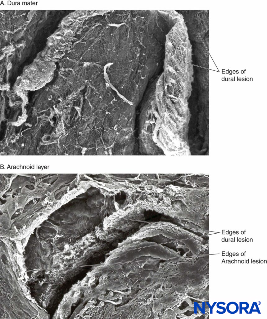 Human dura mater. Dura-arachnoid lesion produced by 25-gauge Quincke needle. Scanning electron microscopy. Magnification ×200. A: Dural surface. B Arachnoid surface.