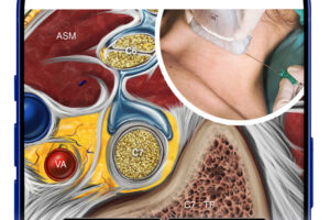 Ultrasound-Guided Interscalene Brachial Plexus Nerve Block