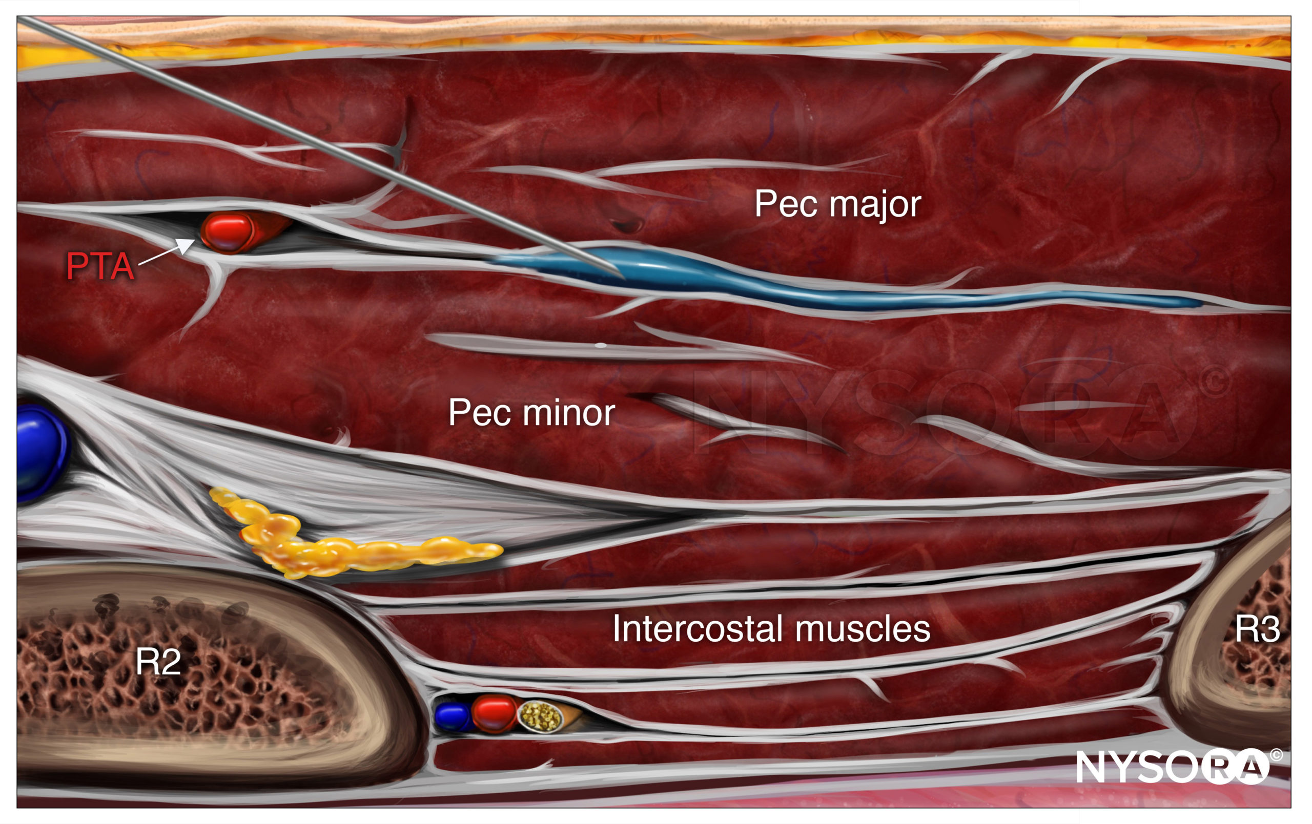 Pectoralis and Serratus Plane Nerve Blocks - NYSORA