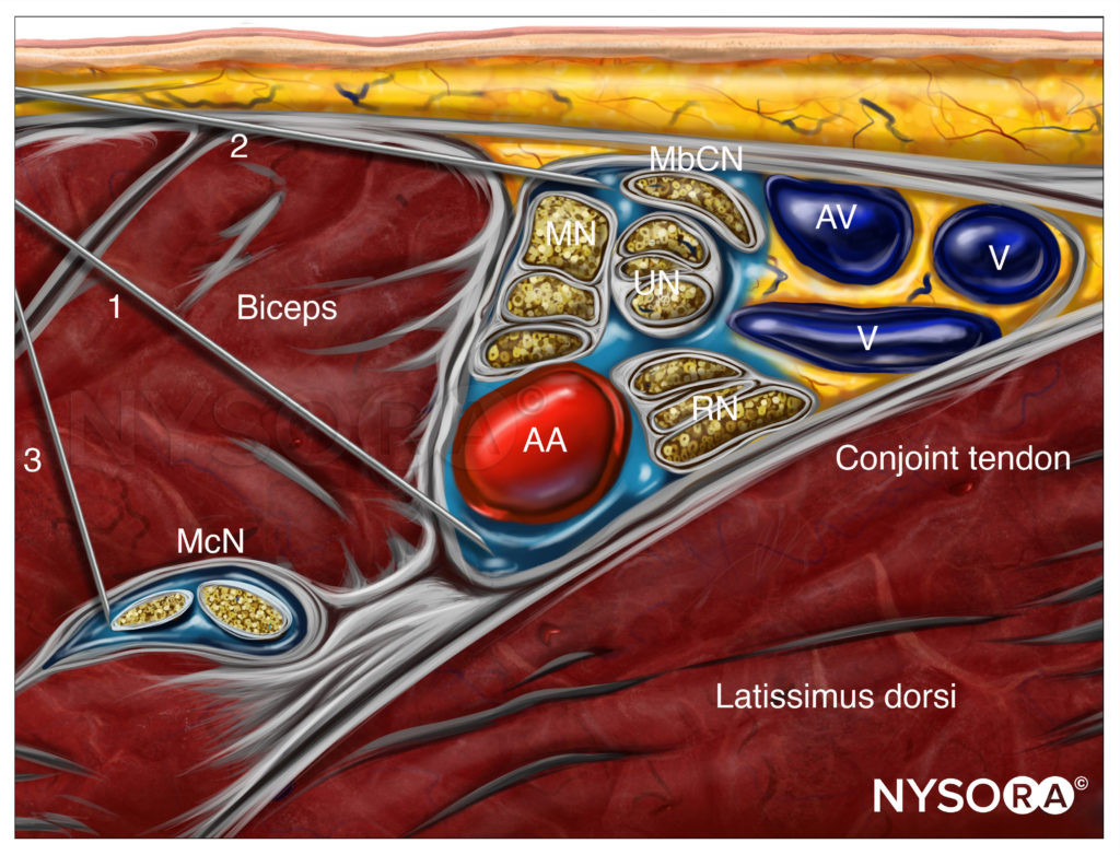 Axillary nerve block