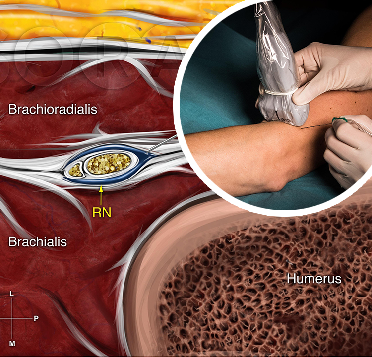 Ultrasound-Guided Blocks at the Elbow