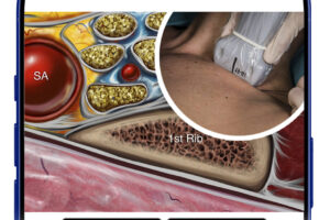 ltrasound Guided Supraclavicular Brachial Plexus Nerve Block