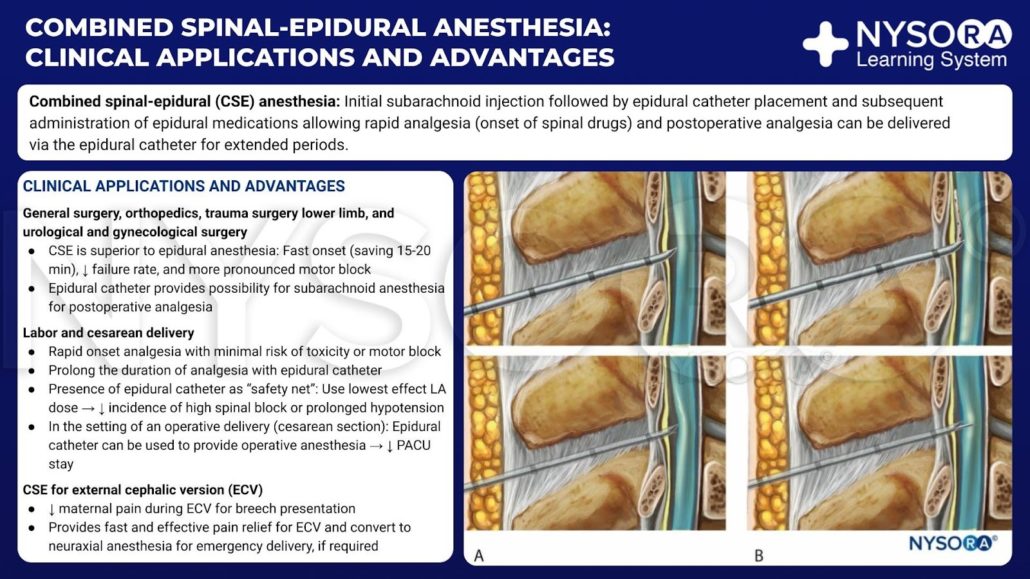 Combined SpinalEpidural Anesthesia NYSORA NYSORA