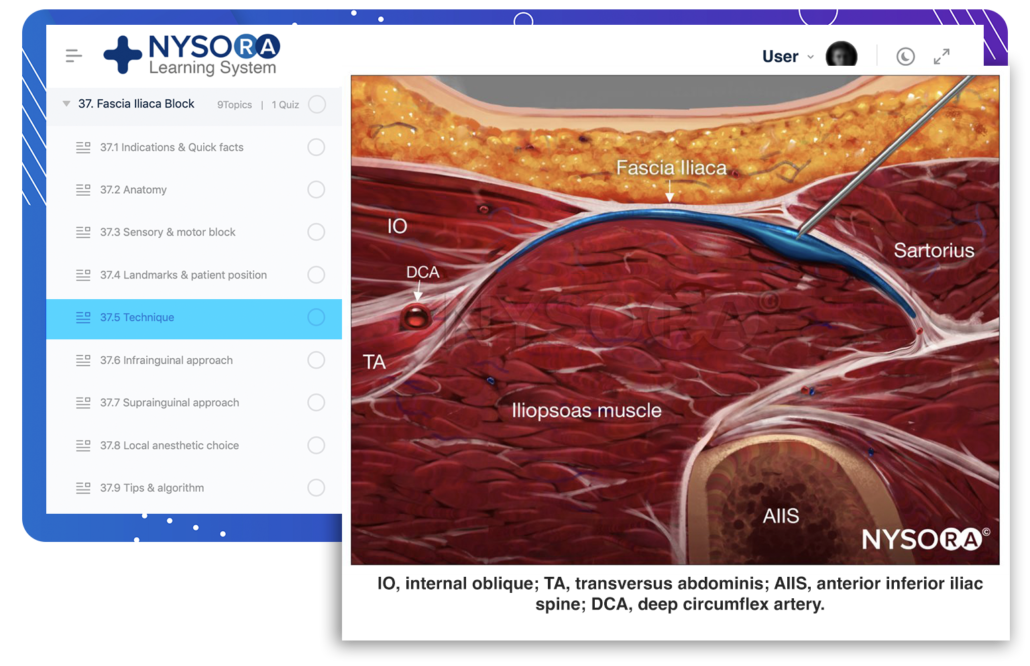 Ultrasound Guided Fascia Iliaca Nerve Block Nysora Ny vrogue.co
