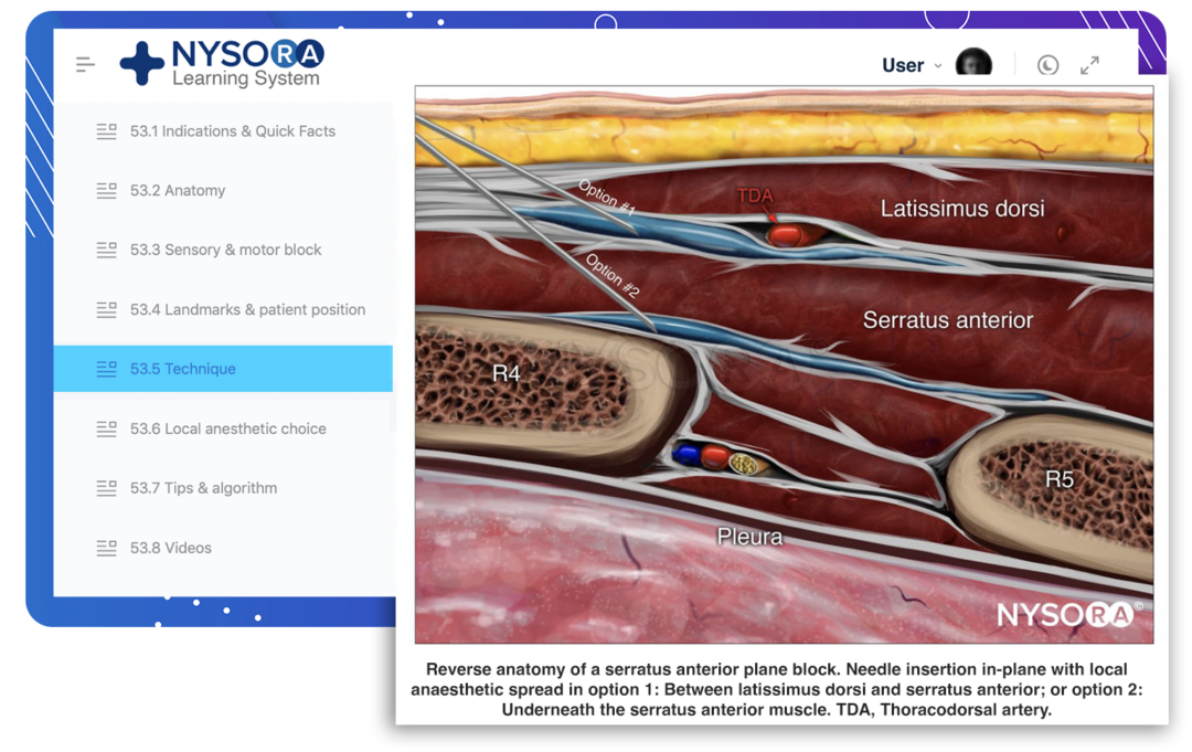 Pectoralis und SerratusPlaneNervenblockaden NYSORA