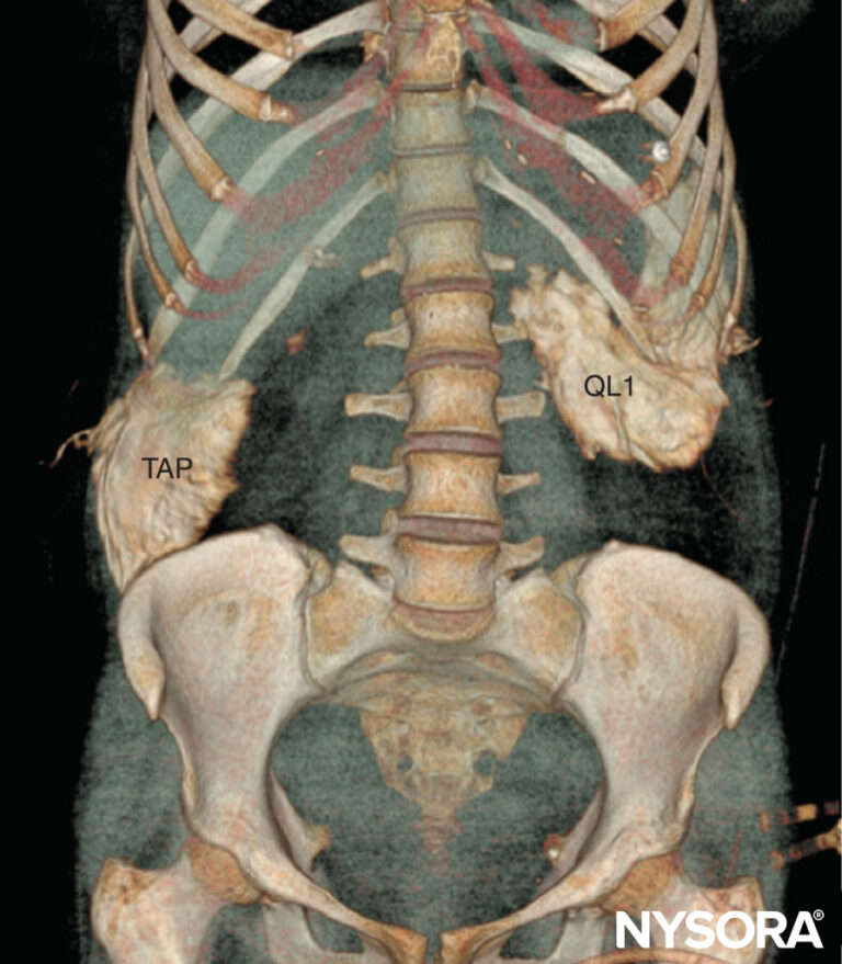 Ultrasound-Guided Transversus Abdominis Plane and Quadratus Lumborum ...