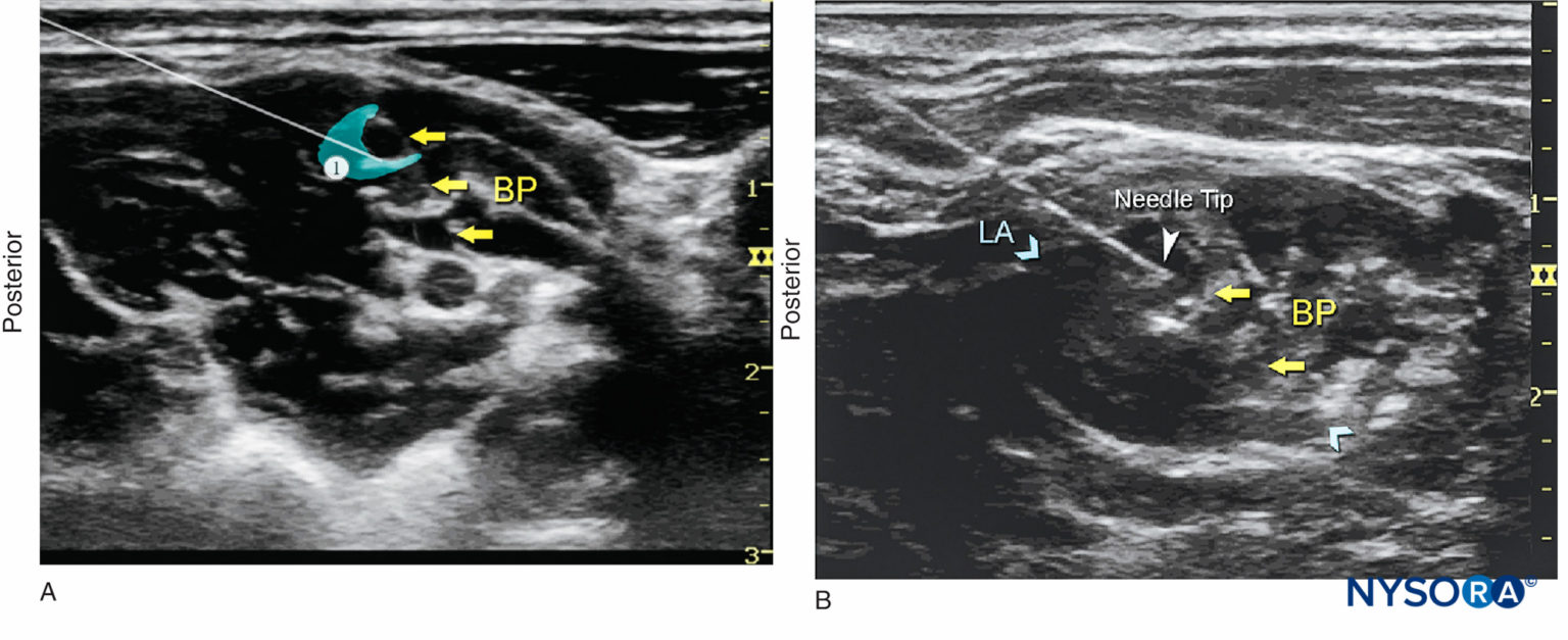 UltrasoundGuided Interscalene Brachial Plexus Nerve Block NYSORA