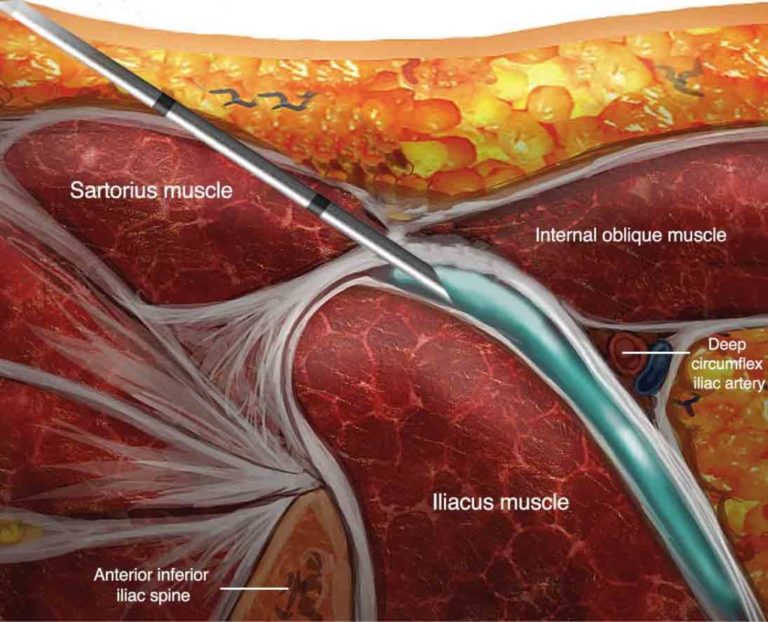 UltrasoundGuided Fascia Iliaca Nerve Block NYSORA NYSORA