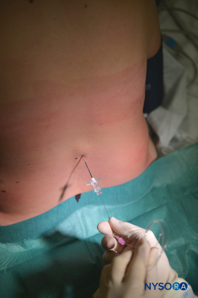 Comparison of abdominal compression devices in persons with abdominal  paralysis due to spinal cord injury