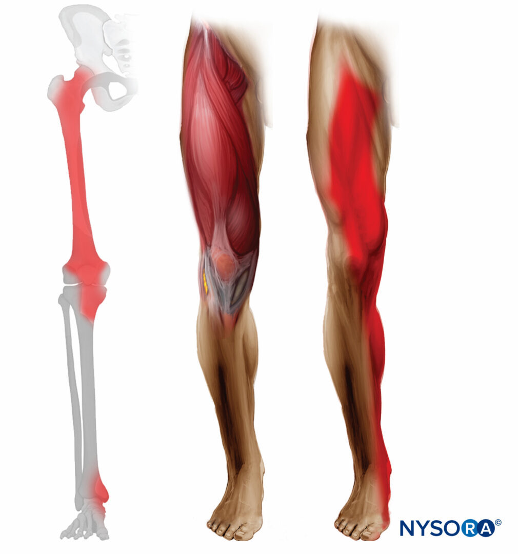 Lower Extremity Nerve Blocks Poster (in) – NYSORA