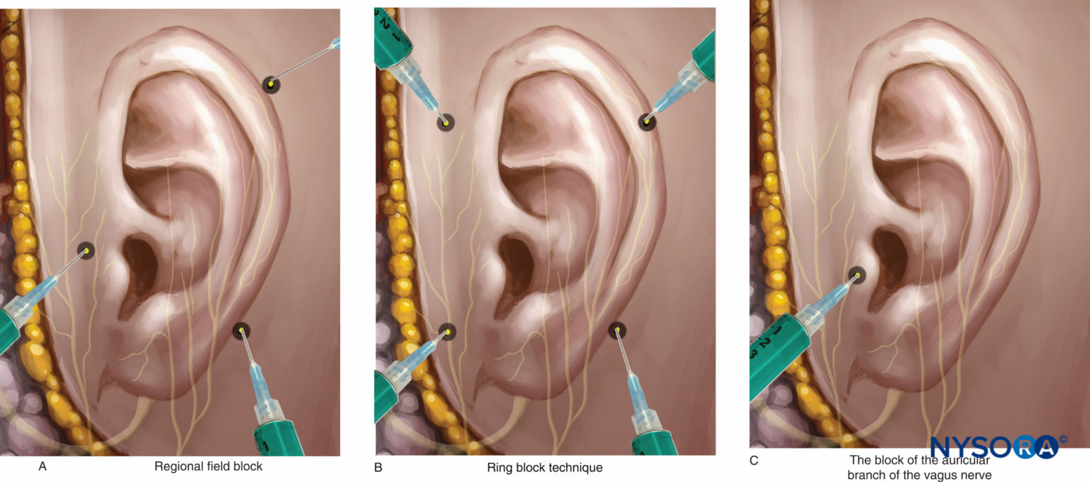 regionalanesthesiaexternalearnerveblocktechniques NYSORA