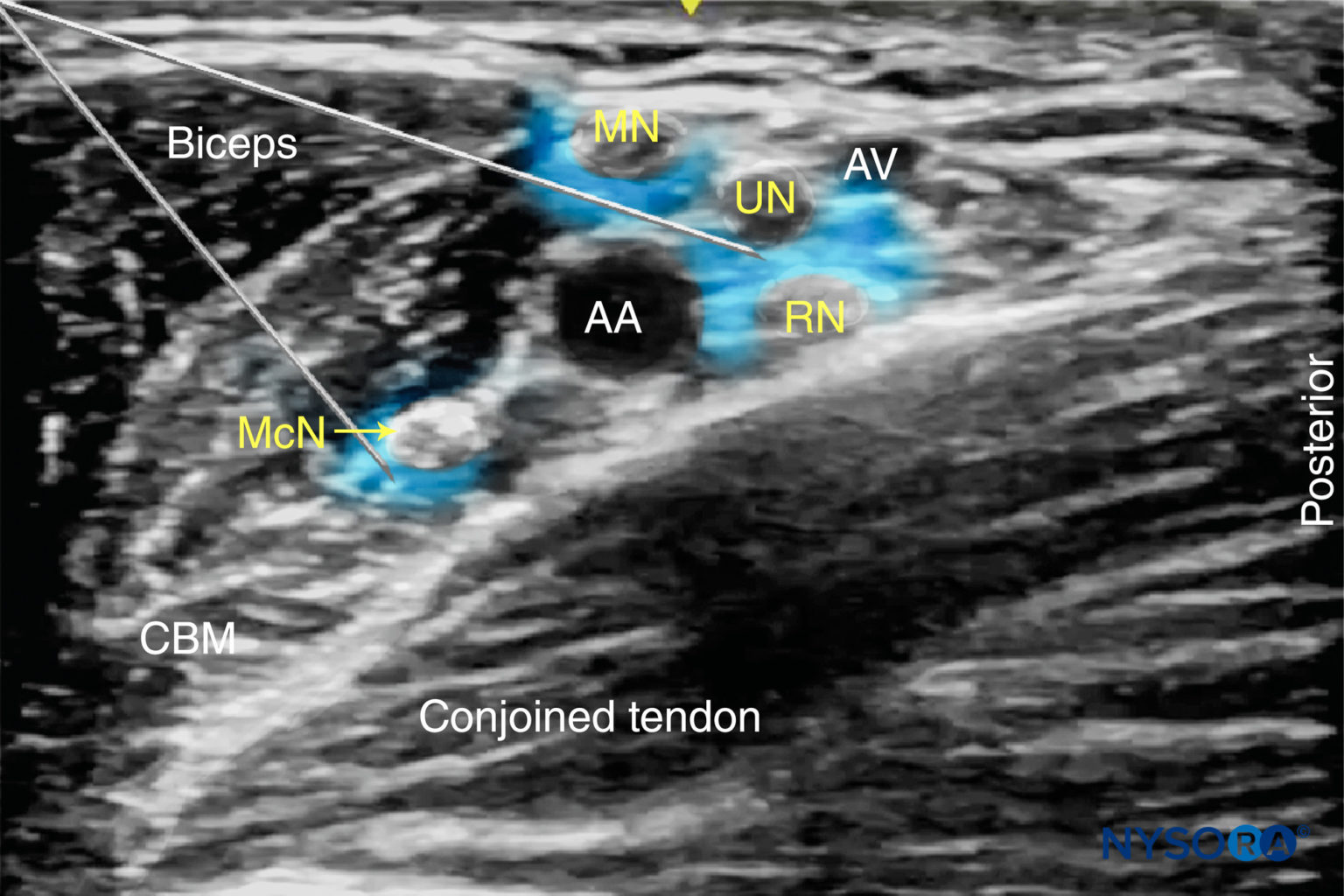 UltrasoundGuided Axillary Brachial Plexus Block NYSORA NYSORA