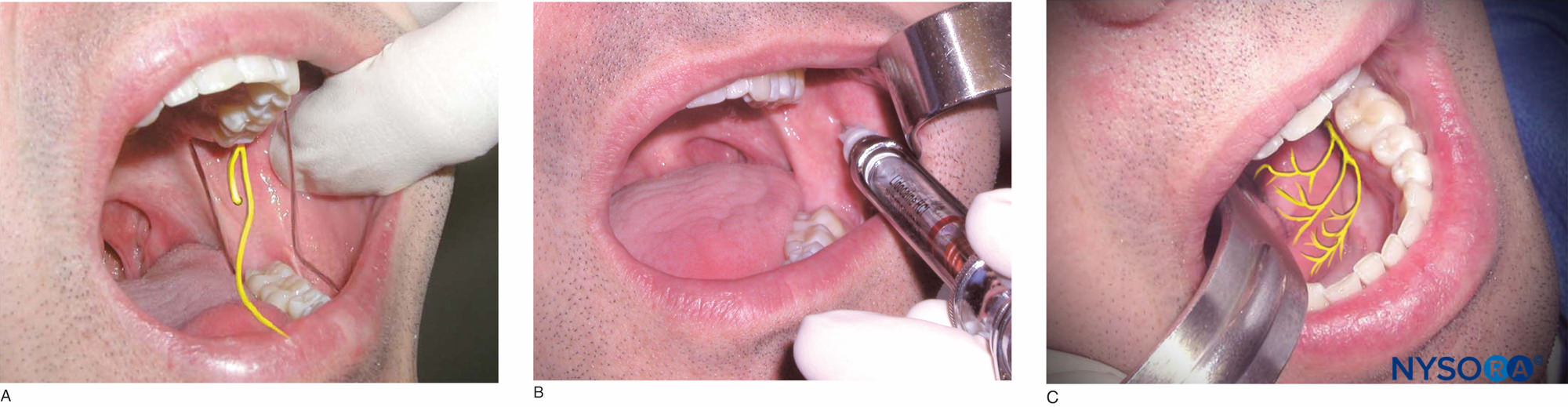 Inferior Alveolar Block Injection