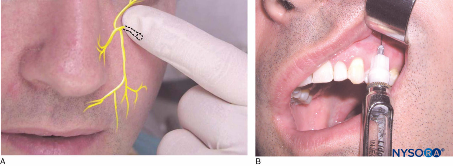anestesiaregionalubicacióndelnervioinfraorbitarioyaguja