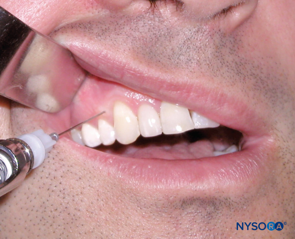 regionalanesthesiaintraseptaltechnique NYSORA NYSORA