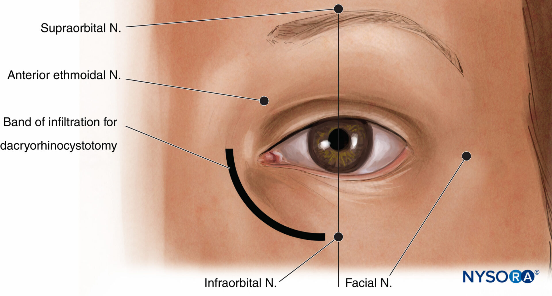 regionalanesthesialandmarksforoculoplasticnerveblocks NYSORA