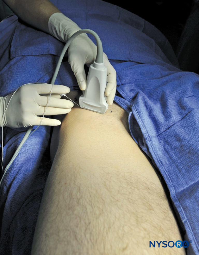 Ultrasound-Guided Fascia Iliaca Nerve Block - NYSORA