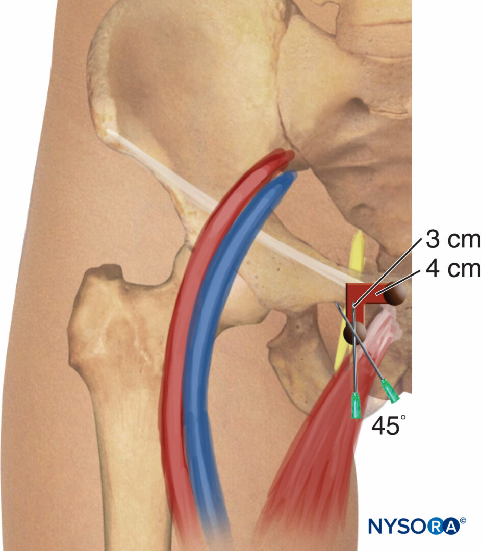 Femoral Nerve Block Nysora