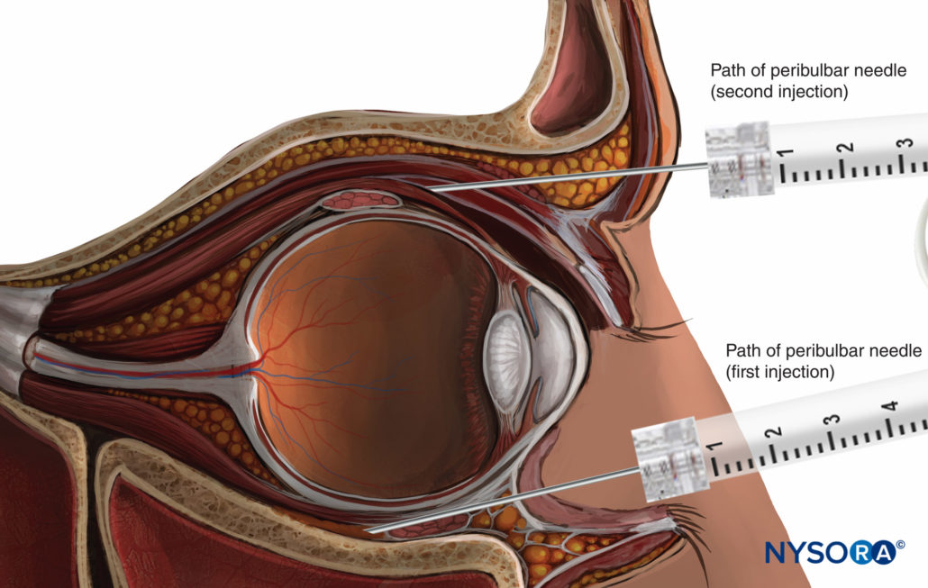 Regional anesthesia peribulbar nerve block superior second injection