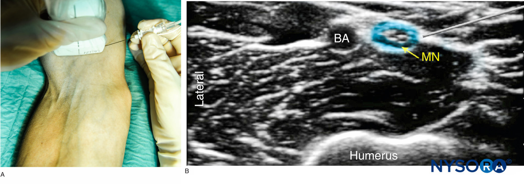 UltrasoundGuided Blocks at the Elbow NYSORA