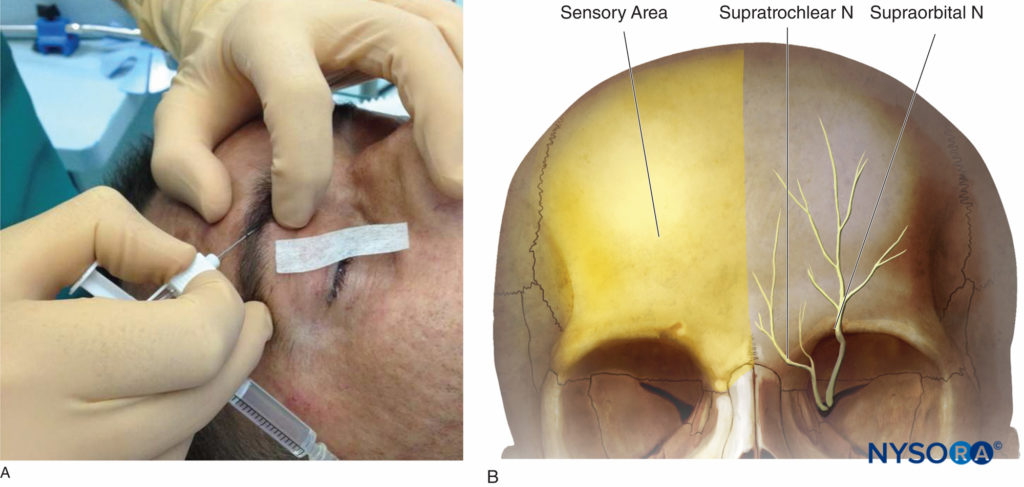 A: Supraorbital and supratrochlear nerve block. B: Sensory area of the supraorbital and supratrochlear nerves.