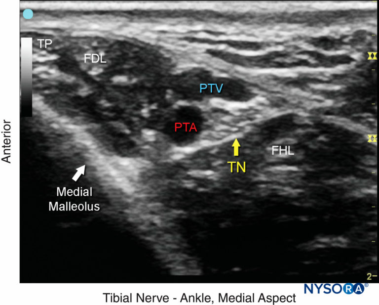 Ultrasound-Guided Ankle Nerve Block