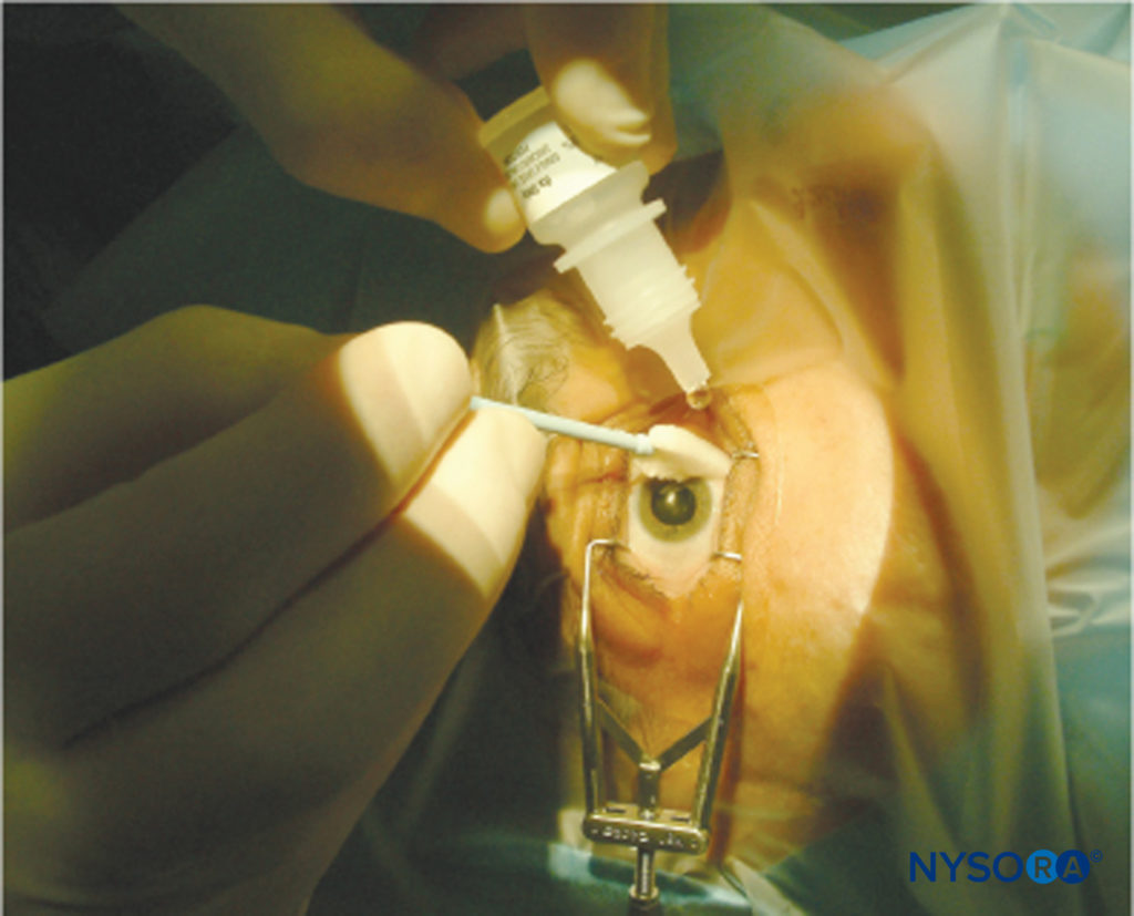Anesthésie locale et régionale pour la chirurgie ophtalmique - NYSORA