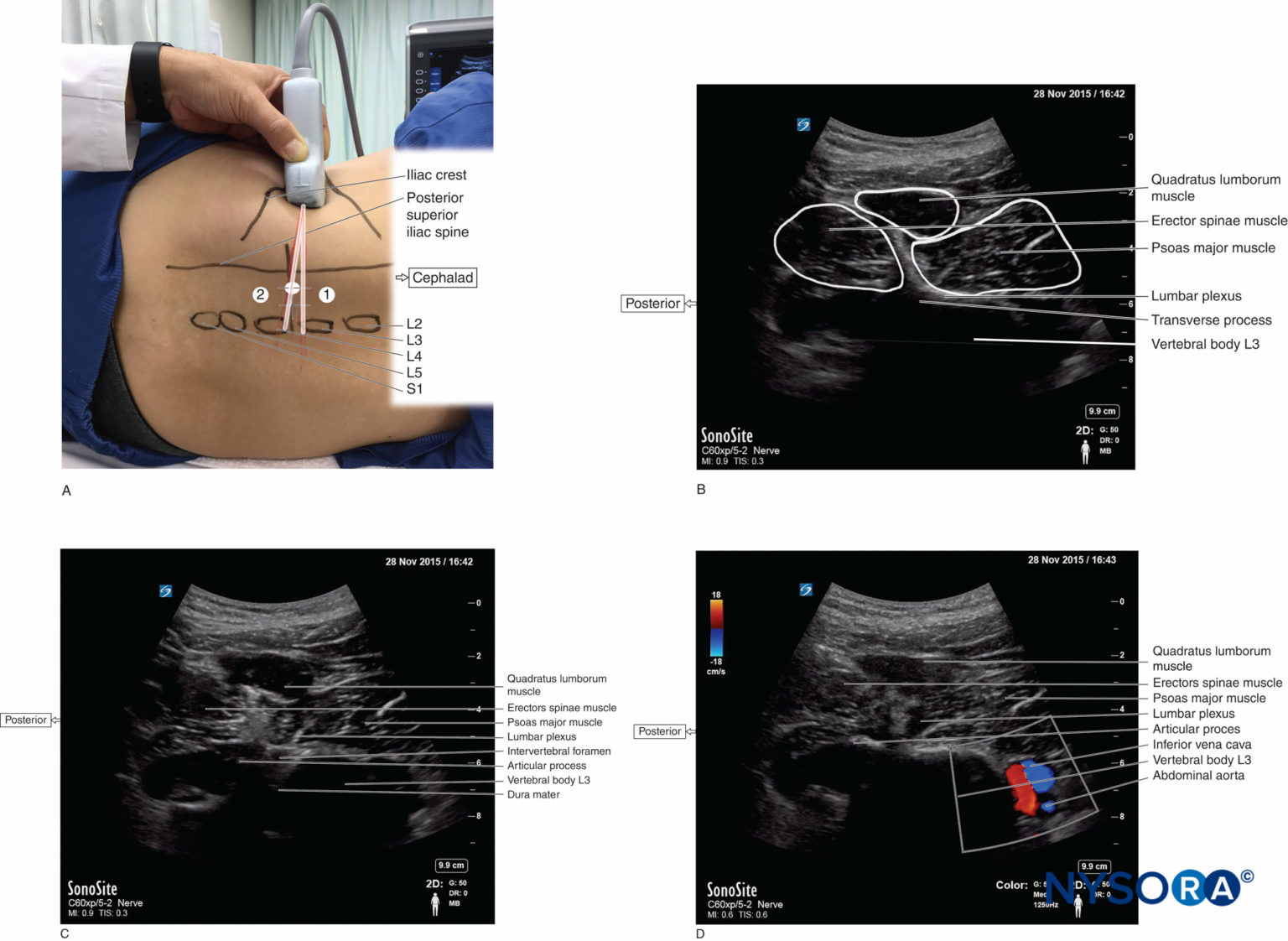 Ecograf a Del Espacio Paravertebral Lumbar Y Consideraciones Para El ecograf-a-del-espacio-paravertebral-lumbar-y-consideraciones-para-el