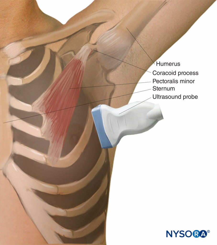 Transducer position required for the serratus plane nerve block.