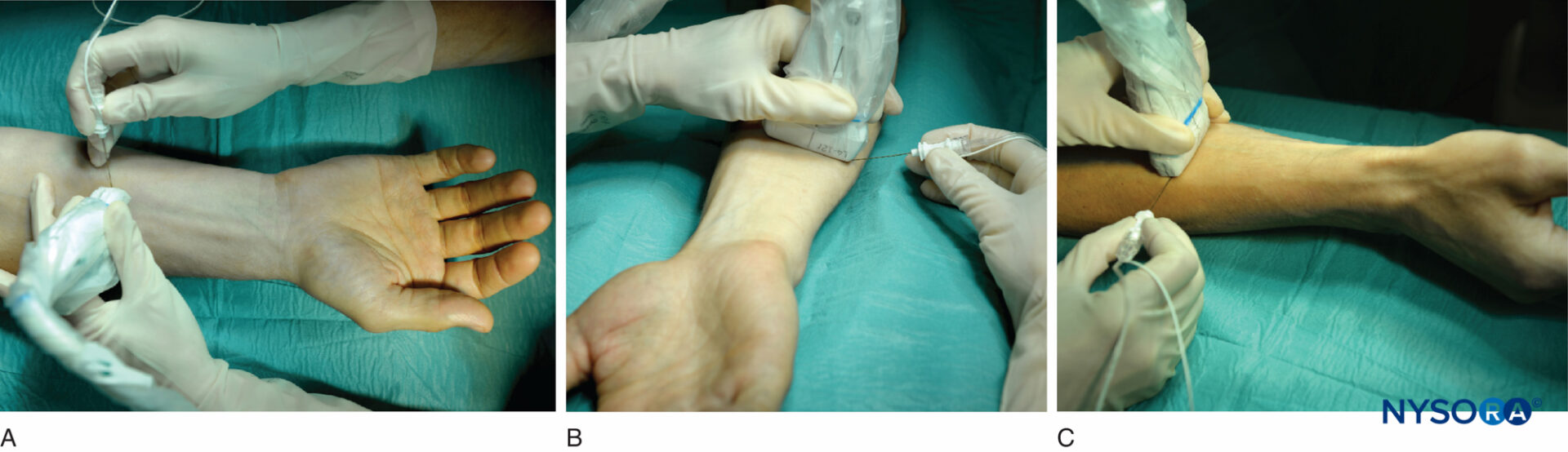 regionalanesthesiaultrasoundguidedwristnerveblock NYSORA NYSORA