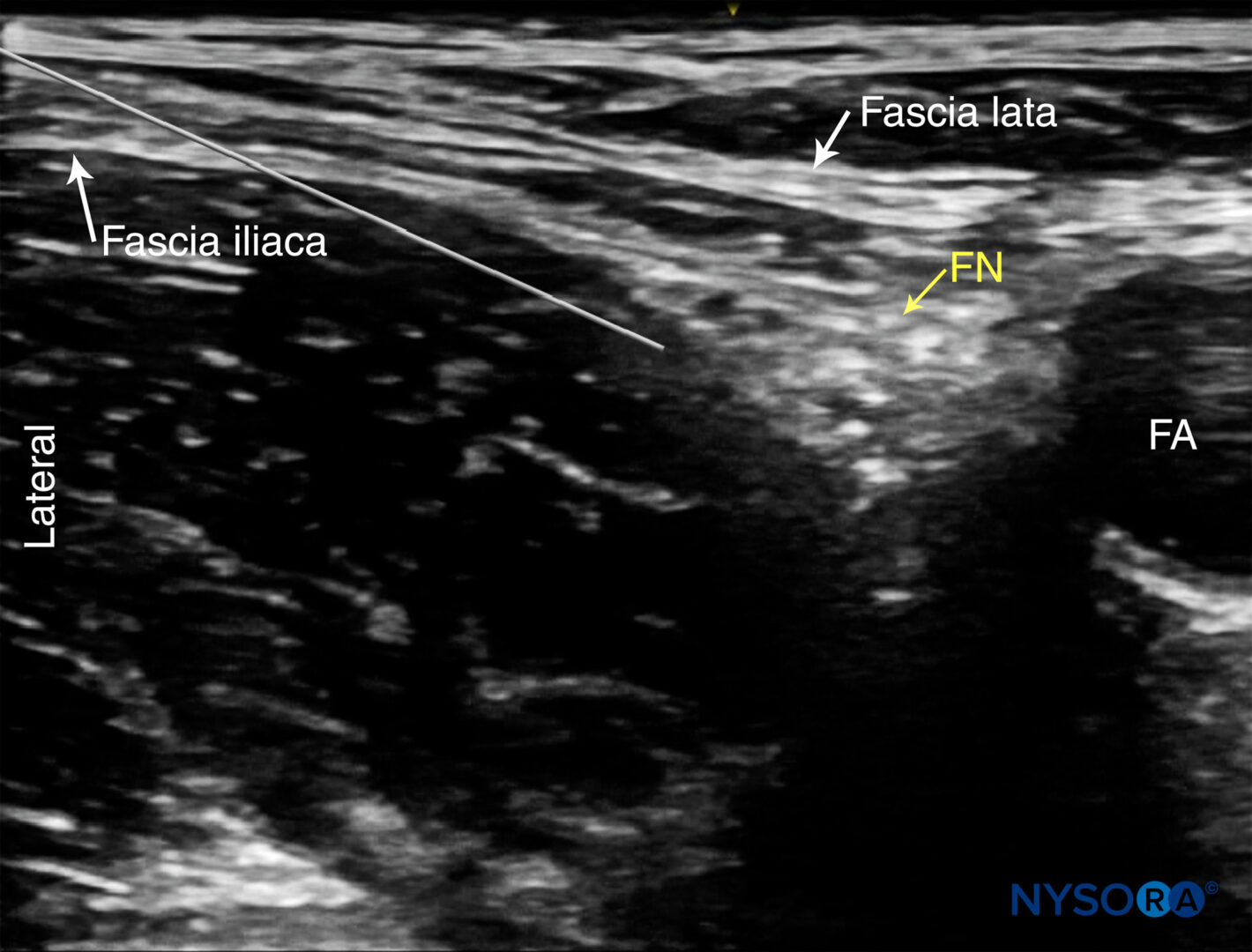 Femoral Nerve Block Nysora Femoral Nerve Block Nysora