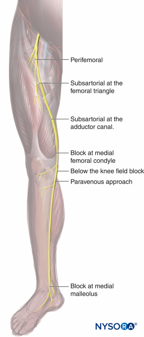 Saphenous Nerve Block