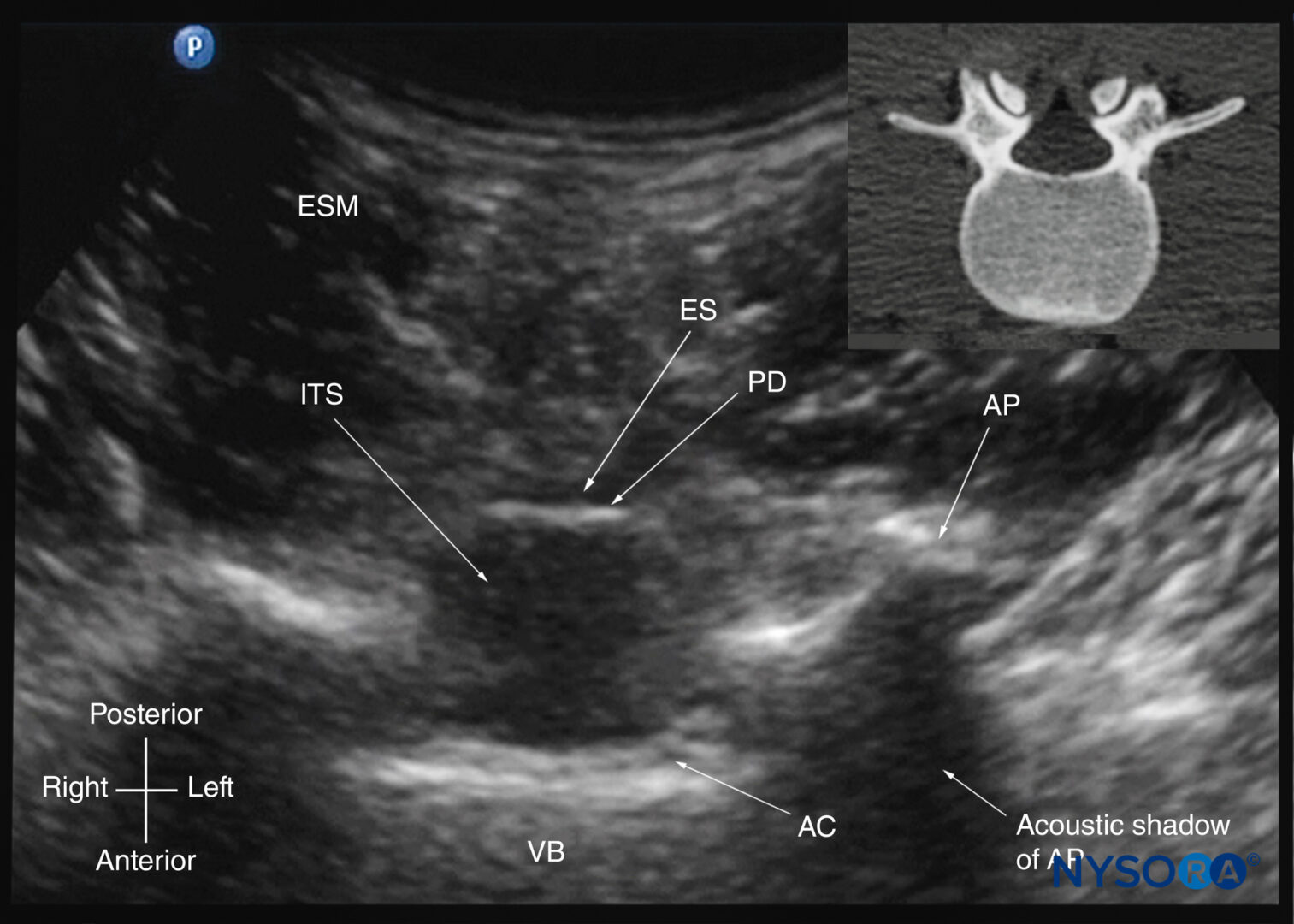 Ultrasound Spine Anatomy