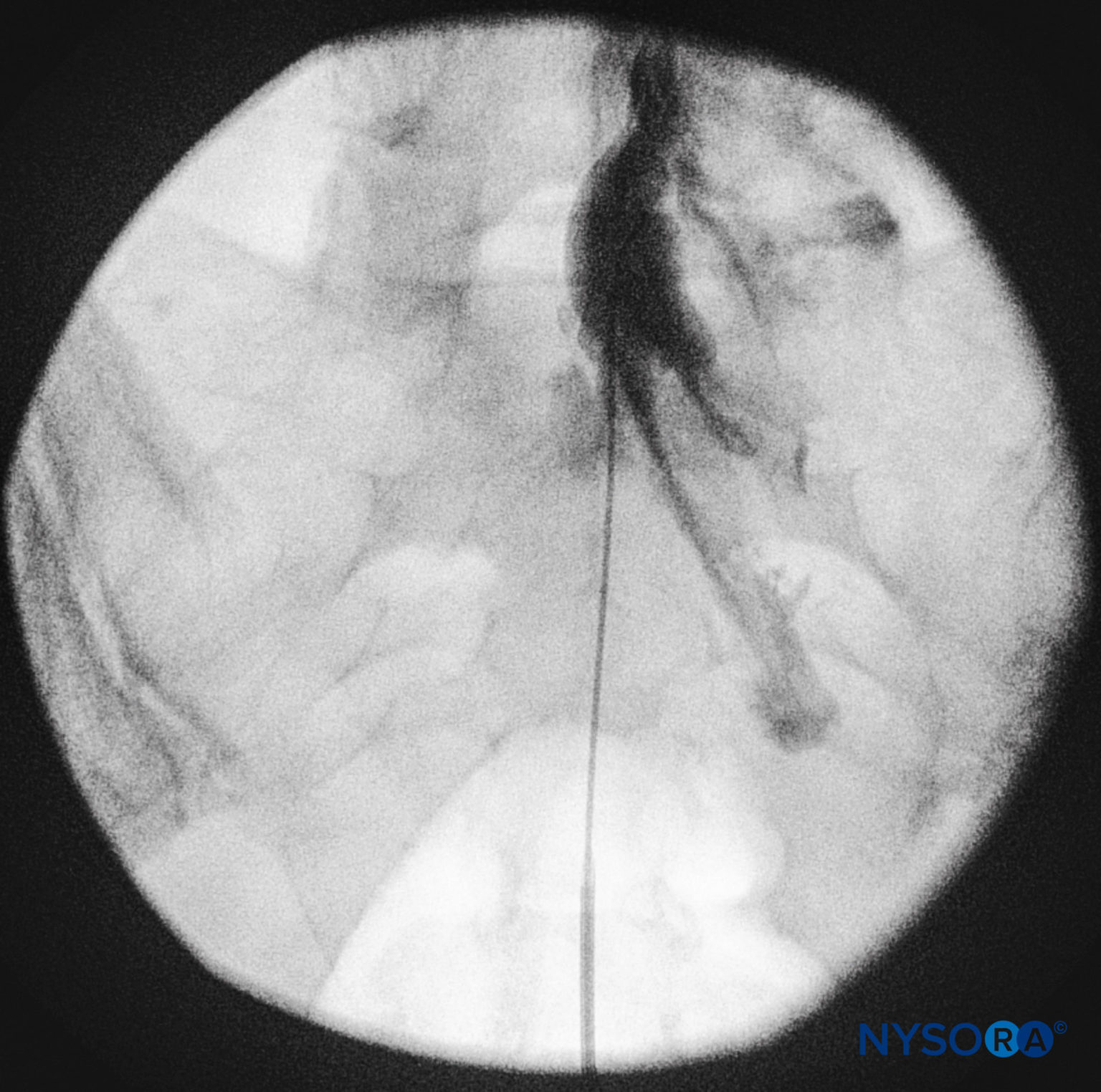 regionalanesthesiaanteroposteriorfluoroscopicimagedepicting