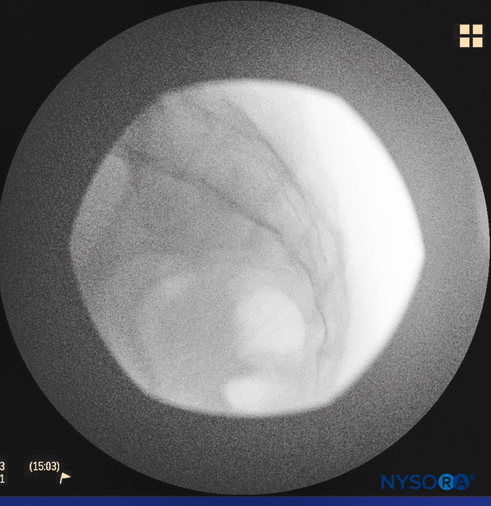 The anatomical boundaries representing the low back.