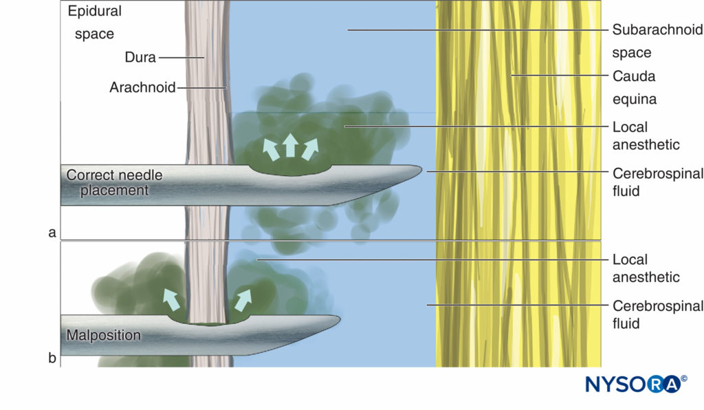 Correct needle placement with (A) all drug delivered to CSF and (B) malposition where some of the drug is lost into the epidural space.