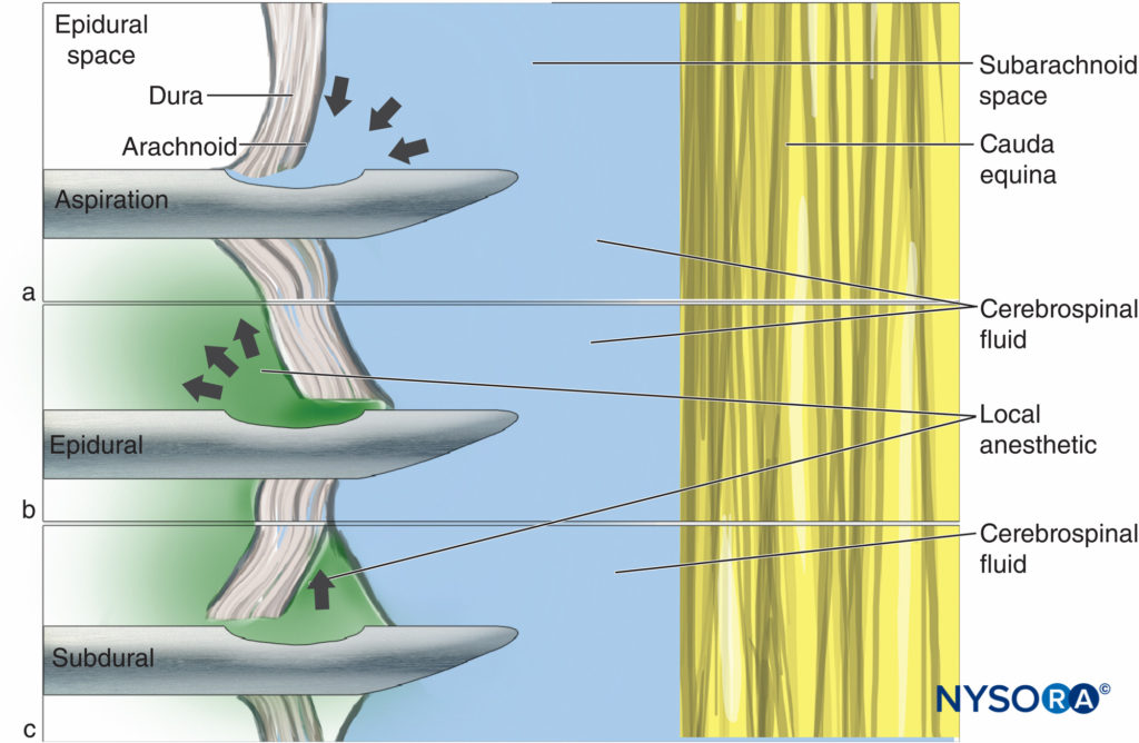 The flap valve effect: (A) CSF is aspirated but on injection the meningeal layers move, resulting in (B) epidural or (C) subdural injection of drug.