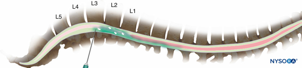 Injection at the second or third lumbar interspace will normally result in a significant fraction of the drug spreading cranially from the point of injection (but too high an injection risks inadvertent damage to the spinal cord).