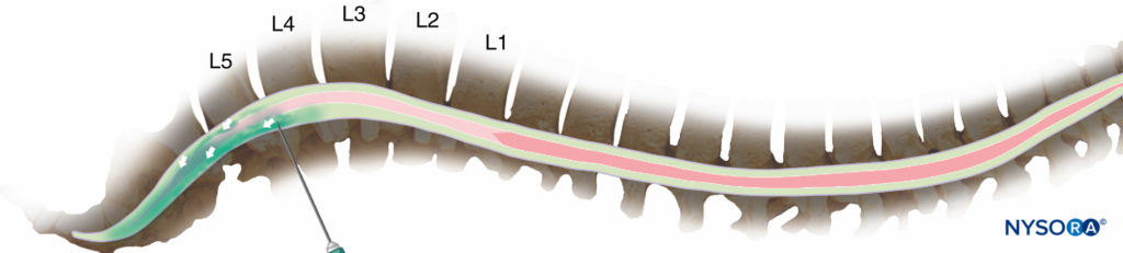Injection at the fourth interspace or lower reduces the risk of cord damage, but it may result in predominantly caudal<br /> spread of the drug and an inadequate block for surgery.