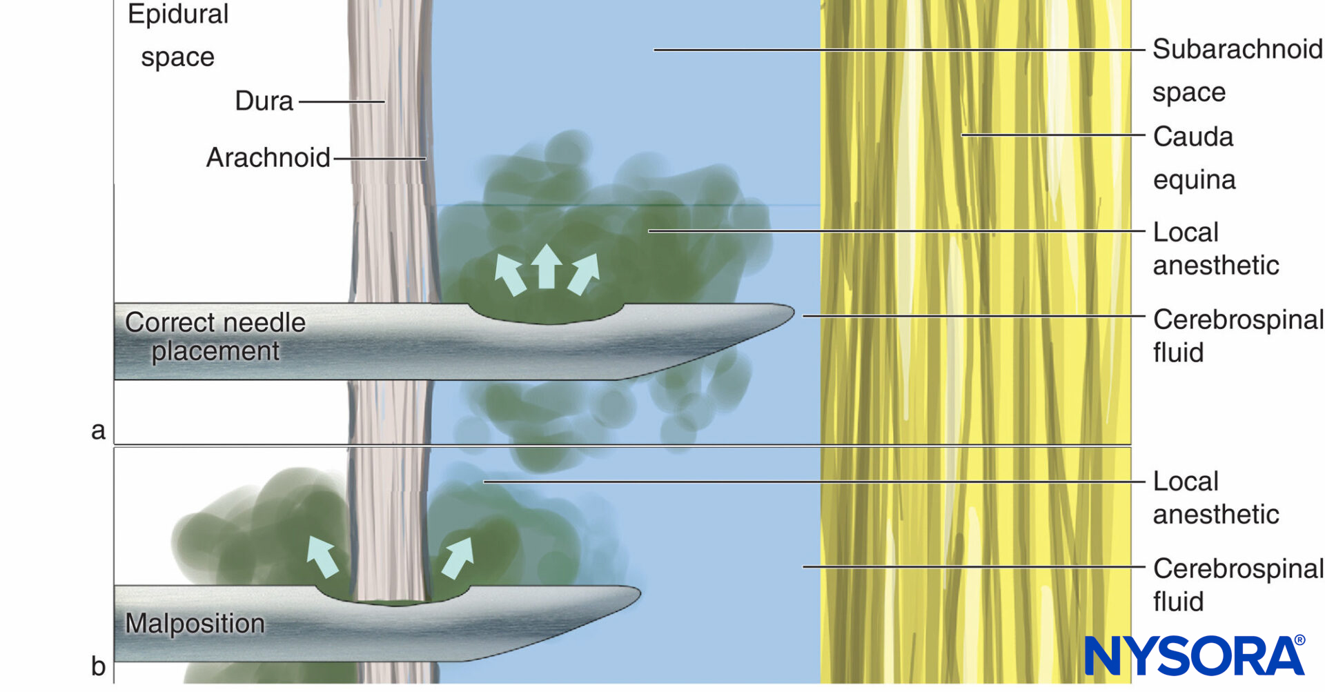Correct needle placement with (A) all drug delivered to CSF and (B) malposition where some of the drug is lost into the epidural space.