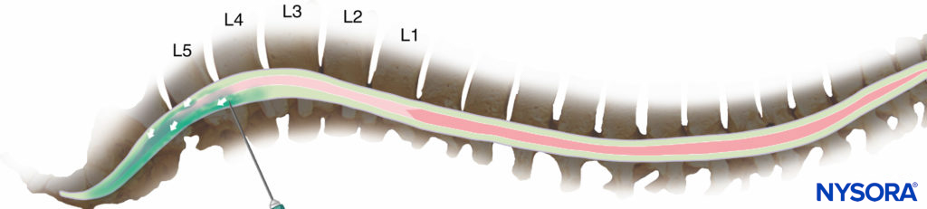 Injection at the fourth interspace or lower reduces the risk of cord damage, but it may result in predominantly caudal<br /> spread of the drug and an inadequate block for surgery.