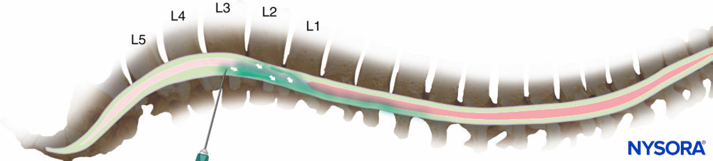 Injection at the second or third lumbar interspace will normally result in a significant fraction of the drug spreading cranially from the point of injection (but too high an injection risks inadvertent damage to the spinal cord).