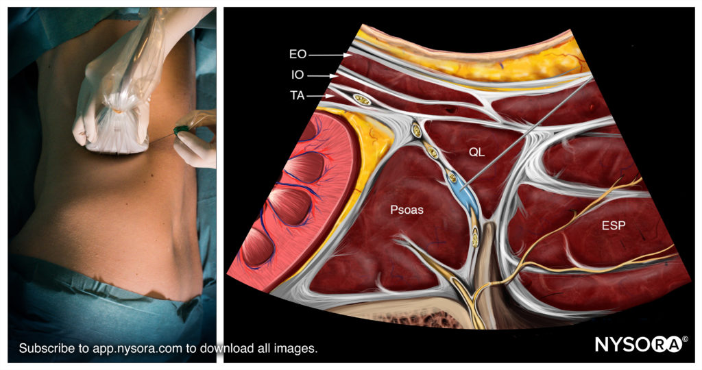 Trunk_QL_Reverse_Needle_QL311024x540 NYSORA