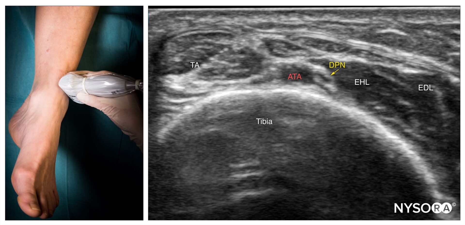 Ultrasound-Guided Ankle Block: NYSORA Web App - NYSORA
