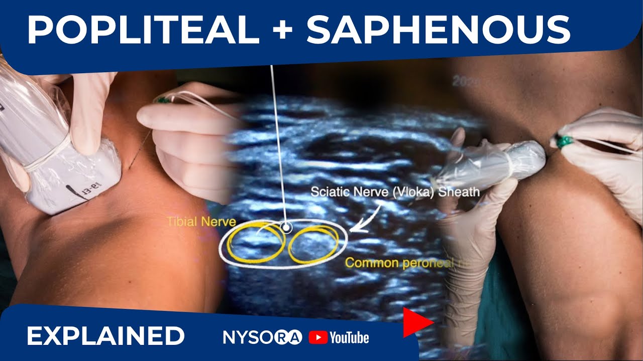 POPLITEAL + SAPHENOUS NERVE BLOCKS FOR ANKLE FRACTURE (VIDEO)