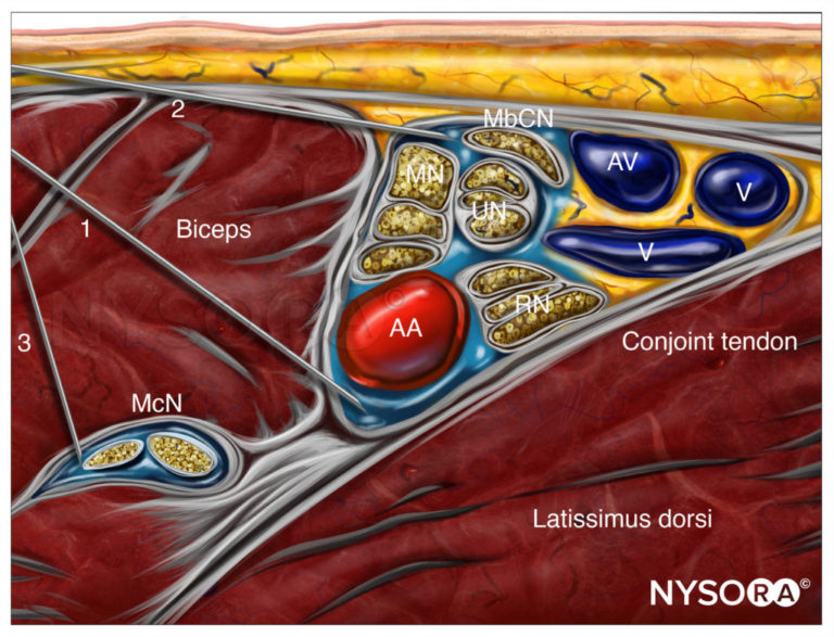 NYSORA Compendium of Regional Anesthesia - Chapter #9: Axillary