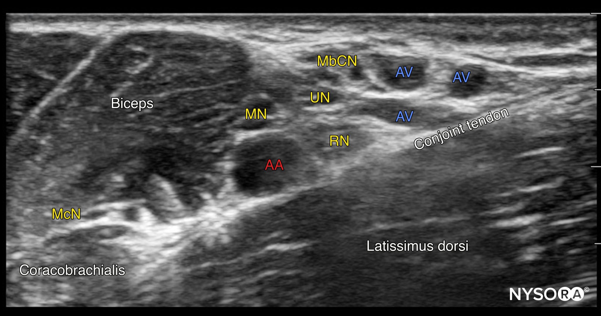 Axillary Brachial Plexus Block Aa Axillary Artery Mn Median Nerve ...