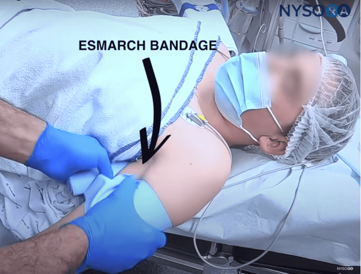 Best Technique for Difficult IV: Crash Course with Dr. Hadzic